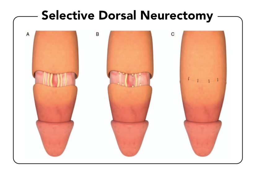 selective dorsal neurectomy