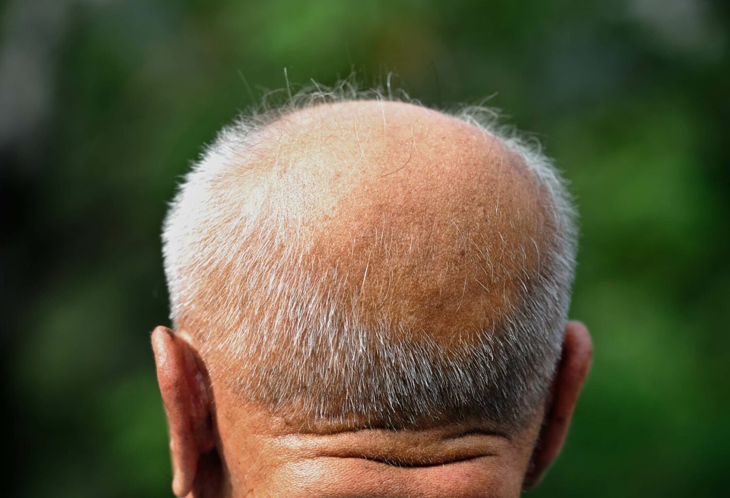 solutions for male hair loss